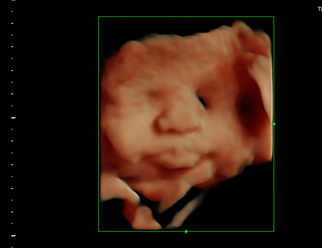 3D ultrasound image at 33 weeks